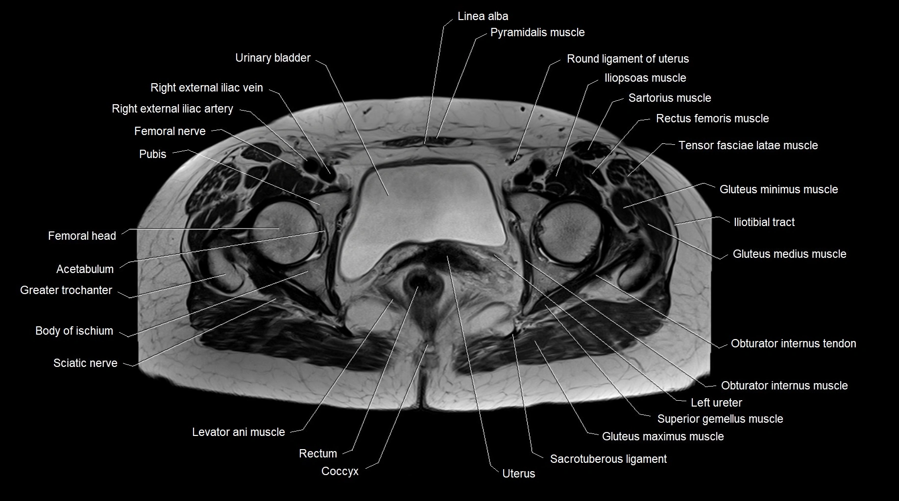 MRI 3T pelvis axial cross section anatomy image 23.webp
